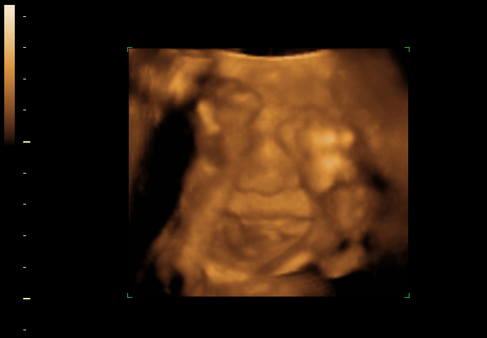 3D ultrasound image at 26 weeks